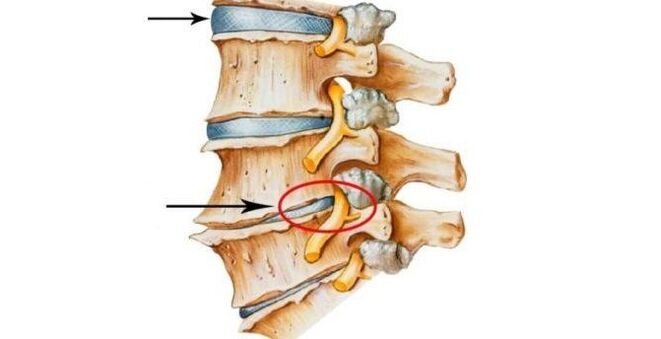 servikal osteokondrozlu sağlıklı ve hasarlı spinal disk