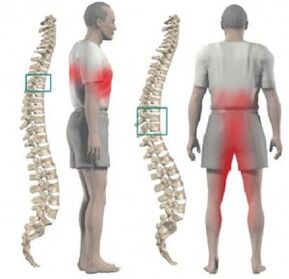 torasik osteokondrozda omurga ve ağrı hasarı