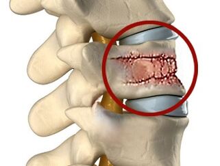 Sırt ağrısının nedenleri, omurga ve omurlararası disklerin hastalıkları olabilir. 