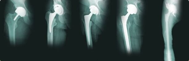 artrozda kalça protezi seçenekleri