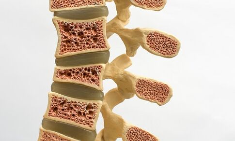 Osteoporoz bel ağrısının nedenlerinden biridir
