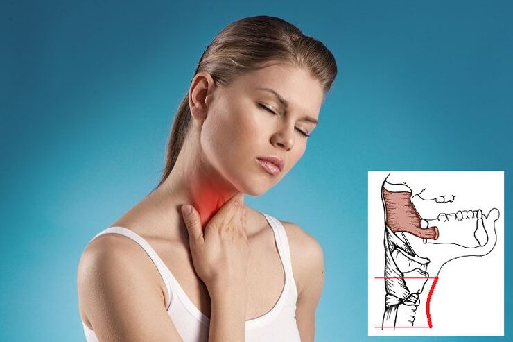 Sinir sıkışmasına bağlı servikal osteokondrozlu boğaz ağrısı