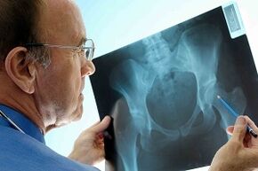 X -Ray üzerindeki kalça ekleminin eklemozu