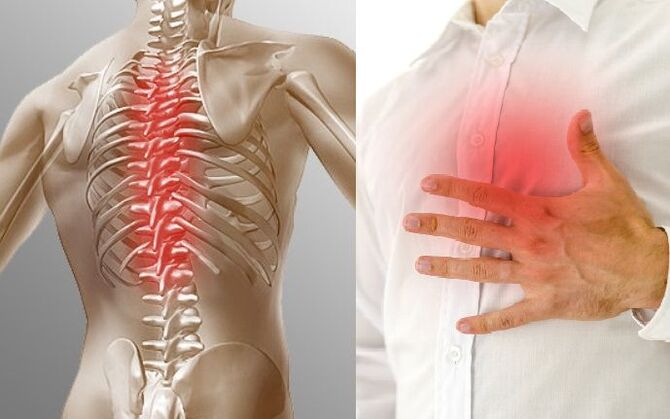 Torasik osteokondroz ve göğüs ağrısı