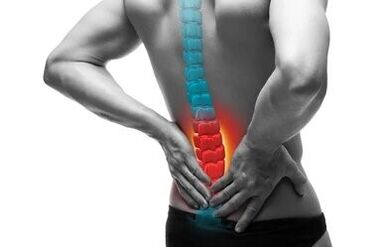 Osteokondroz omurganın bir hastalığıdır