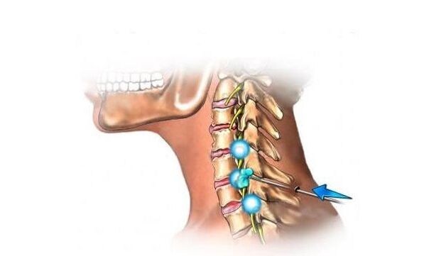 servikal omurganın osteokondrozu