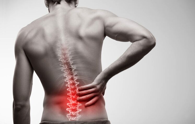 Osteokondroz nedeniyle bel ağrısı