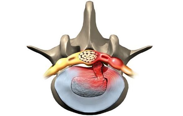 Osteokondrozdan etkilenen vertebra