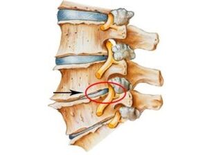 Osteokondroz belirtileri ve semptomları
