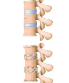 Osteokondrozun nedenleri